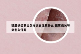 銀屑病關(guān)節(jié)炎怎樣飲食注意什么 銀屑病關(guān)節(jié)炎怎么保養(yǎng)