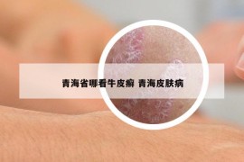 青海省哪看牛皮癬 青海皮膚病