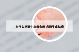 為什么點(diǎn)滴牛皮癬會(huì)癢 點(diǎn)滴牛皮膚癬
