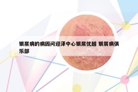 銀屑病的病因問迎澤中心銀屑優(yōu)越 銀屑病俱樂部