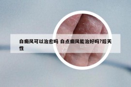 白癜風(fēng)可以治愈嗎 白點(diǎn)癲風(fēng)能治好嗎?后天性