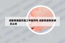 成都銀康醫(yī)院是三甲醫(yī)院?jiǎn)?成都銀康銀屑病 怎么樣