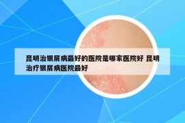 昆明治銀屑病最好的醫(yī)院是哪家醫(yī)院好 昆明治療銀屑病醫(yī)院最好