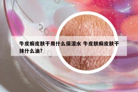 牛皮癬皮膚干用什么保濕水 牛皮膚癬皮膚干抹什么油?