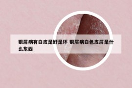 銀屑病有白皮是好是壞 銀屑病白色皮屑是什么東西