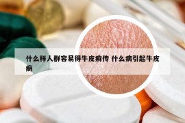 什么樣人群容易得牛皮癬傳 什么病引起牛皮癬