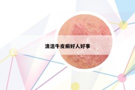 清潔牛皮癬好人好事