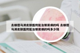 去順德馬洲皮膚醫(yī)院能治銀屑病的嗎 去順德馬洲皮膚醫(yī)院能治銀屑病的嗎多少錢