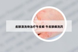 皮膚清洗塊治療牛皮癬 牛皮膚癬洗藥