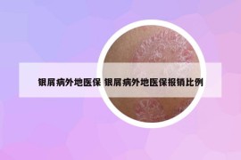 銀屑病外地醫(yī)保 銀屑病外地醫(yī)保報(bào)銷比例