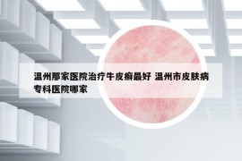 溫州那家醫(yī)院治療牛皮癬最好 溫州市皮膚病?？漆t(yī)院哪家