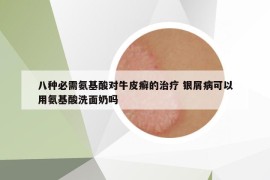 八種必需氨基酸對(duì)牛皮癬的治療 銀屑病可以用氨基酸洗面奶嗎
