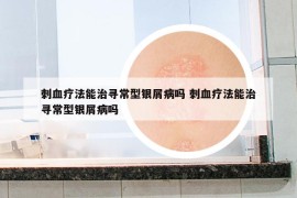 刺血療法能治尋常型銀屑病嗎 刺血療法能治尋常型銀屑病嗎