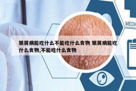 銀屑病能吃什么不能吃什么食物 銀屑病能吃什么食物,不能吃什么食物