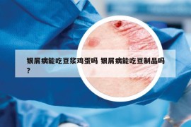 銀屑病能吃豆?jié){雞蛋嗎 銀屑病能吃豆制品嗎?