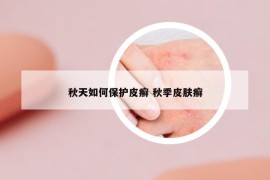 秋天如何保護(hù)皮癬 秋季皮膚癬