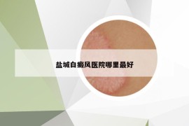 鹽城白癜風(fēng)醫(yī)院哪里最好
