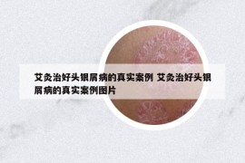 艾灸治好頭銀屑病的真實案例 艾灸治好頭銀屑病的真實案例圖片
