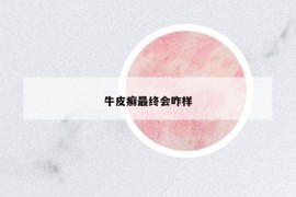 牛皮癬最終會咋樣