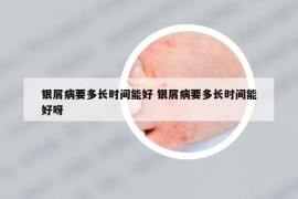 銀屑病要多長時間能好 銀屑病要多長時間能好呀
