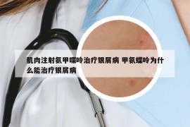 肌肉注射氨甲喋呤治療銀屑病 甲氨蝶呤為什么能治療銀屑病