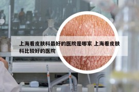 上?？雌つw科最好的醫(yī)院是哪家 上海看皮膚科比較好的醫(yī)院