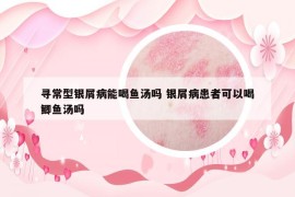 尋常型銀屑病能喝魚湯嗎 銀屑病患者可以喝鯽魚湯嗎