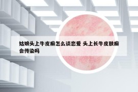 姑娘頭上牛皮癬怎么談戀愛 頭上長牛皮膚癬會傳染嗎