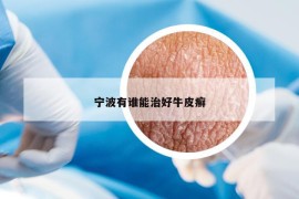 寧波有誰能治好牛皮癬