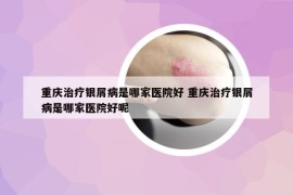 重慶治療銀屑病是哪家醫(yī)院好 重慶治療銀屑病是哪家醫(yī)院好呢