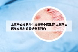 上海華山皮膚科牛皮癬哪個醫(yī)生好 上海華山醫(yī)院皮膚科銀屑病專家預約