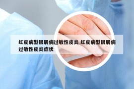 紅皮病型銀屑病過敏性皮炎 紅皮病型銀屑病過敏性皮炎癥狀