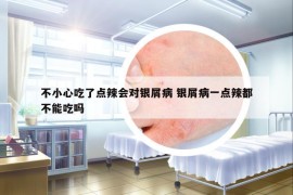 不小心吃了點(diǎn)辣會(huì)對(duì)銀屑病 銀屑病一點(diǎn)辣都不能吃嗎