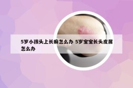 5歲小孩頭上長癬怎么辦 5歲寶寶長頭皮屑怎么辦