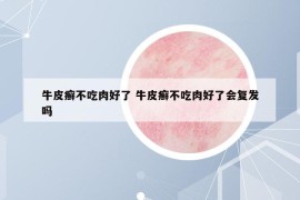 牛皮癬不吃肉好了 牛皮癬不吃肉好了會(huì)復(fù)發(fā)嗎