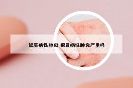 銀屑病性肺炎 銀屑病性肺炎嚴(yán)重嗎
