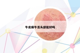 牛皮癬牛舌頭舔能好嗎