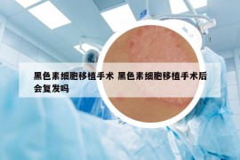 黑色素細(xì)胞移植手術(shù) 黑色素細(xì)胞移植手術(shù)后會(huì)復(fù)發(fā)嗎