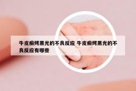 牛皮癬烤黑光的不良反應(yīng) 牛皮癬烤黑光的不良反應(yīng)有哪些
