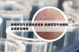 膿皰疹型牛皮癬脫皮現(xiàn)象 膿皰疹型牛皮癬脫皮現(xiàn)象有哪些