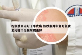 吃氨肽素治好了牛皮癬 氨肽素片和復方氨肽素片哪個治銀屑病更好