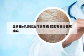 尿素維e乳膏能治療銀屑病 尿素乳膏治銀屑病嗎