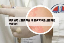 銀屑病可以基因篩查 銀屑病可以通過基因檢測排除嗎