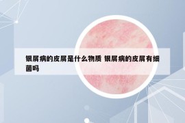 銀屑病的皮屑是什么物質(zhì) 銀屑病的皮屑有細(xì)菌嗎