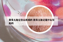 新生兒胎記怎么形成的 新生兒胎記是什么引起的