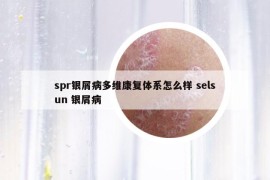 spr銀屑病多維康復(fù)體系怎么樣 selsun 銀屑病