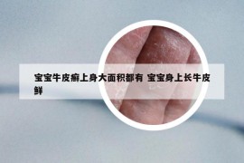寶寶牛皮癬上身大面積都有 寶寶身上長牛皮鮮