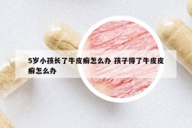 5歲小孩長(zhǎng)了牛皮癬怎么辦 孩子得了牛皮皮癬怎么辦