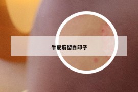 牛皮癬留白印子