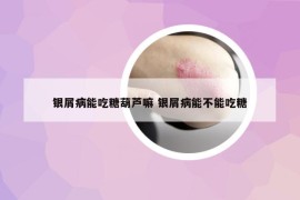 銀屑病能吃糖葫蘆嘛 銀屑病能不能吃糖